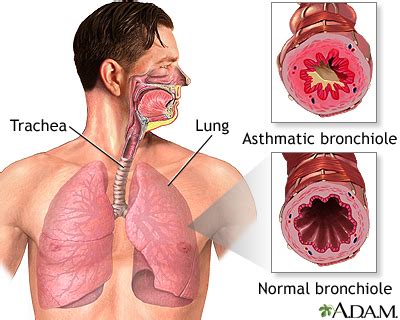 Asthmatic bronchiole and normal bronchiole: MedlinePlus Medical Encyclopedia Image