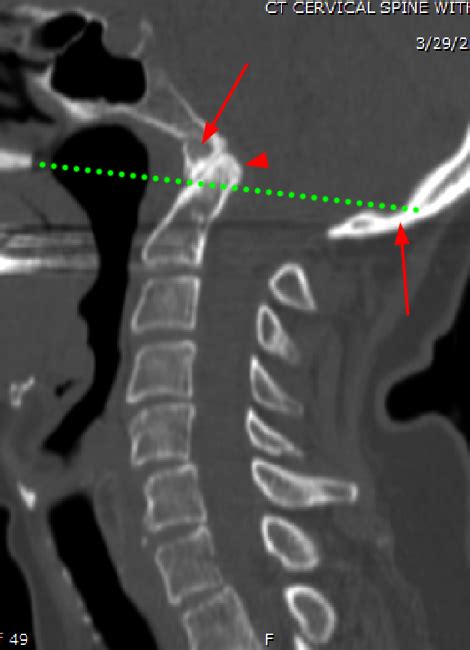 Common Peroneal Nerve Mri