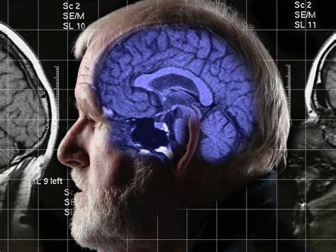 Why is this Alzheimer’s breakthrough so important? | Guernsey Press