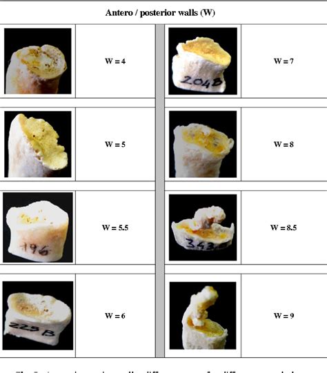 Age-at-death estimation in Caucasian females from the morphological ...