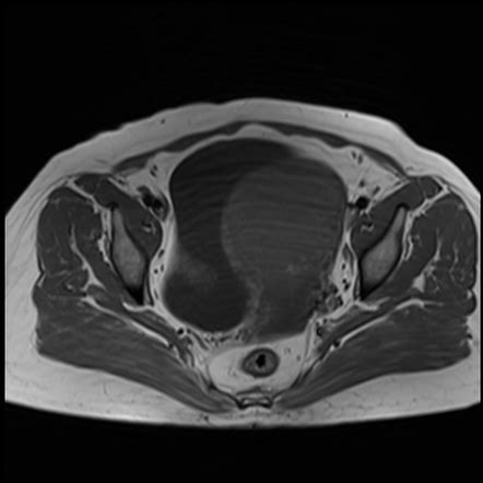 Intramural fibroid (MRI) | Radiology Case | Radiopaedia.org