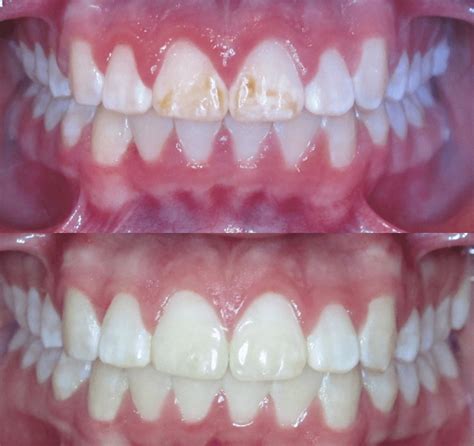 Case Study 61 – Brown Stains on teeth | Bandeen Orthodontics - Battle Creek