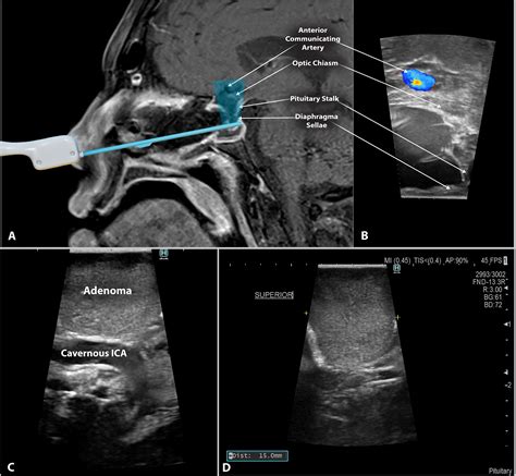 Diaphragma Sellae Mri