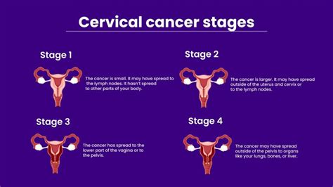 Cervical Cancer: What is it, Symptoms, Stages, Treatment