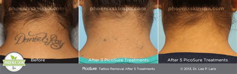 Experience PicoSure Tattoo Removal At - Phoenix Skin Spa