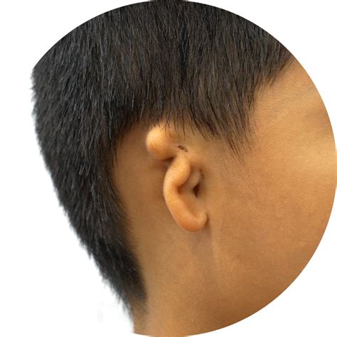 Microtia Treatment - Beverly Hills, CA - Dr. John Reinisch