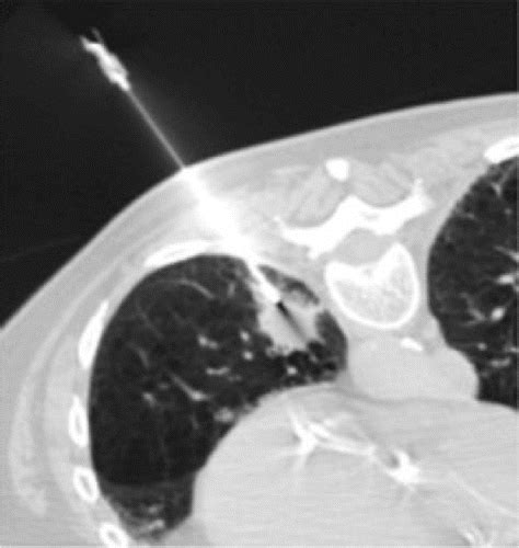 CT-guided Lung Biopsy: Effect of Biopsy-side Down Position on Pneumothorax and Chest Tube ...