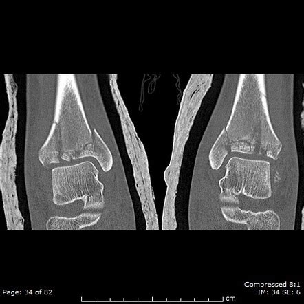 Tibial Plafond