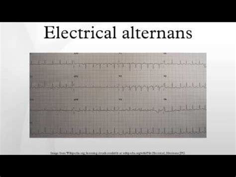 Electrical alternans - YouTube