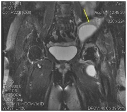 An atypical case of noninfected iliopsoas bursitis - MRI findings ...