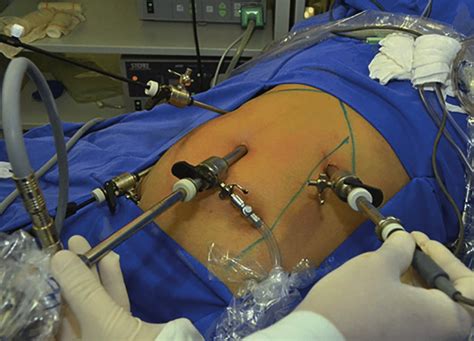 Conventional laparoscopic cholecystectomy. | Download Scientific Diagram