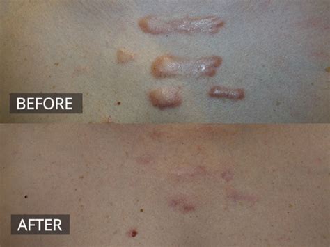 Keloid Scar Removal Treatment | The DOC Clinic Melbourne