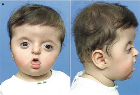 Craniosynostosis and Plagiocephaly | Nurse Key