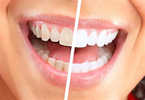 Teeth Whitening Northern Ireland – The Safest Cosmetic Dentistry Procedure Available