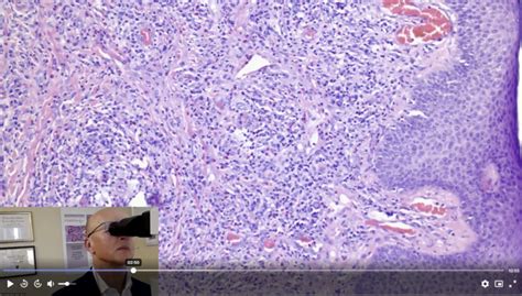 Histological Differential Diagnosis Of Granuloma Faciale Like Inflammatory Reaction | Dermpedia