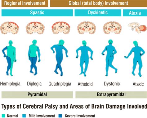 ภาวะสมองพิการ (Cerebral Palsy) - คลินิกกายภาพบำบัดก้าวระรินสุข สาขา ...