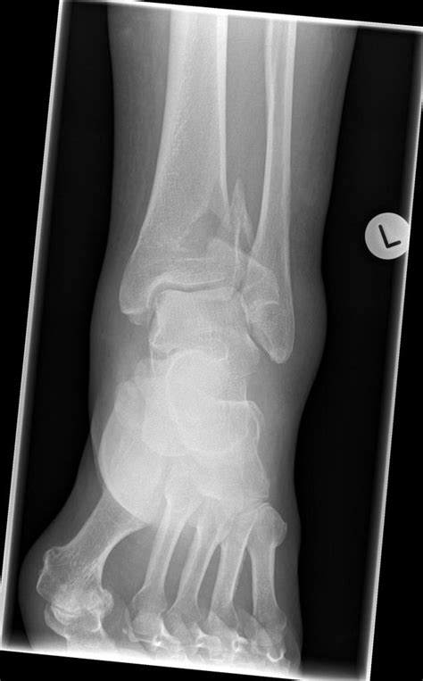 Ankle Plafond Fracture