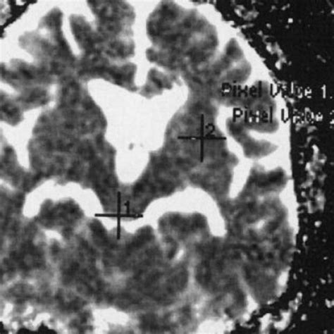 Tectal glioma: diffusion MRI and endoscopic third ventriculostomy | Eurorad