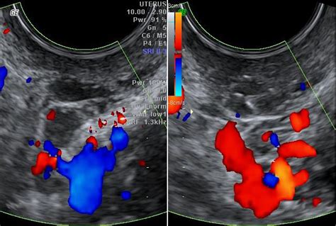 Trans-vaginal ultrasound – JOSEF PFLUG VASCULAR LABORATORY