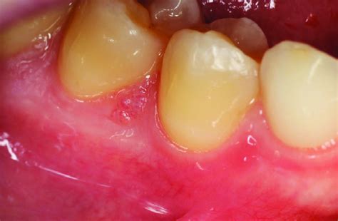 Clinical appearance of the lymphatic malformation. An elevated lesion ...