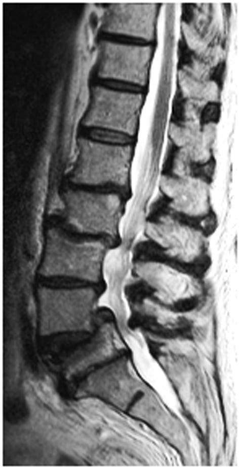 Herniated Disc Thoracic Mri