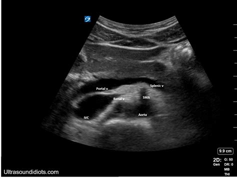 Ultrasound Idiots — Aorta