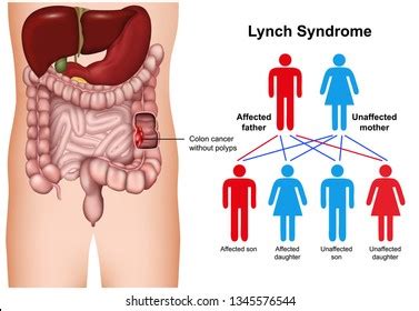 22 Lynch Syndrome Images, Stock Photos, and Vectors | Shutterstock