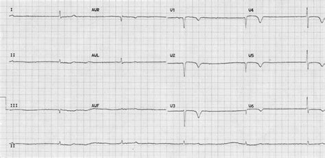 Hypothyroidism ECG changes • LITFL • ECG Library