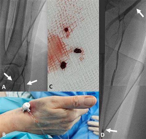 Distal radial approach to reaccess and recanalize the occluded radial artery