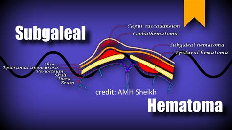 Subgaleal Hematoma – Sonographic Tendencies