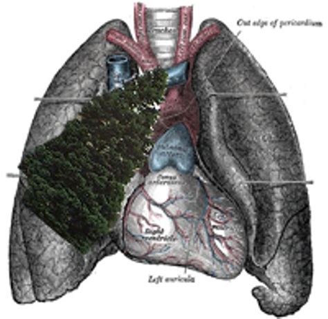 Signs of Spring: Fir Tree Found Growing in Man's Lungs | News Blog