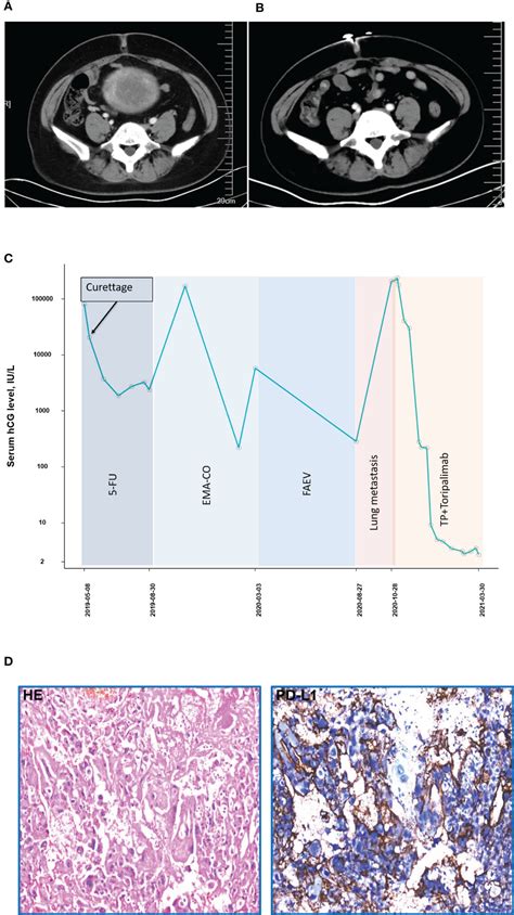 Frontiers | Effectiveness and Safety of Toripalimab Combination Therapies for Patients With ...