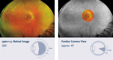 Optomap – Stephen Cuddy Optometrists