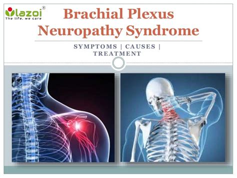 Brachial Plexus Neuropathy Syndrome : Causes, Symptoms, Daignosis and…