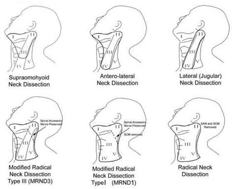 Neck Dissection Lymph Node Removal