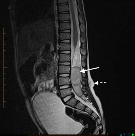 Myelomalacia: Causes, Symptoms, and Treatment