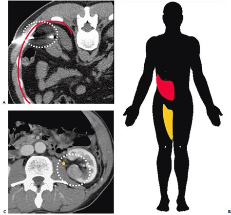 7 Kidney Ablation | Radiology Key