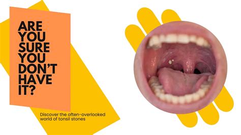 Tonsil Stones: Causes, Symptoms, and Medications • Quattro Club Journals