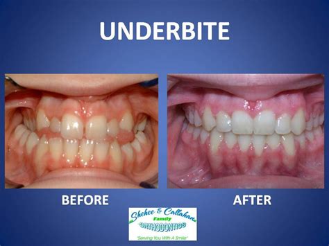 Braces before and after - underbite | Braces before and after, Dental braces, Braces