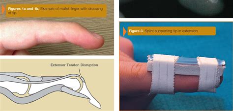 Mallet Finger (Baseball Finger) | Wrist injury, Therapy, Physical therapy