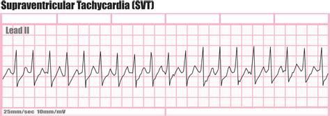 Holter monitor uses, instructions, preparations and Holter monitor results