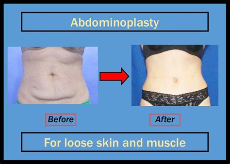 Pin on Abdominoplasty - Tummy Tuck