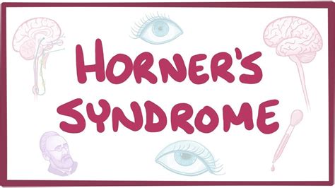 Horner's syndrome - causes, symptoms, diagnosis, treatment, pathology ...