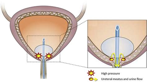 Increased pressure due to the Foley balloon and benefit of side... | Download Scientific Diagram