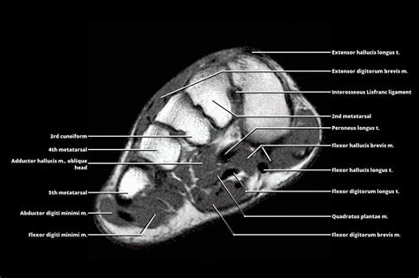 MRI - FOOT