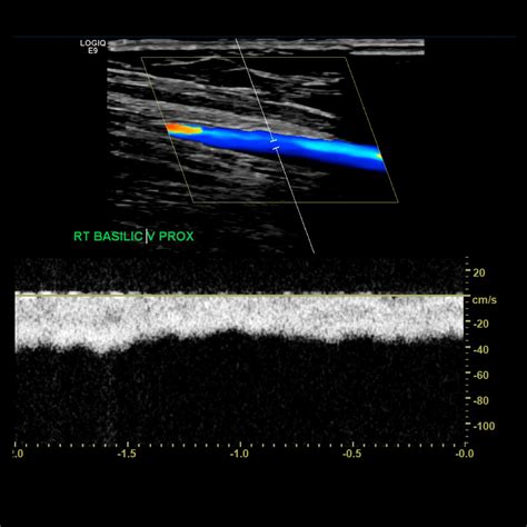 Upper Extremity Venous Doppler – Sonographic Tendencies | Vascular ...