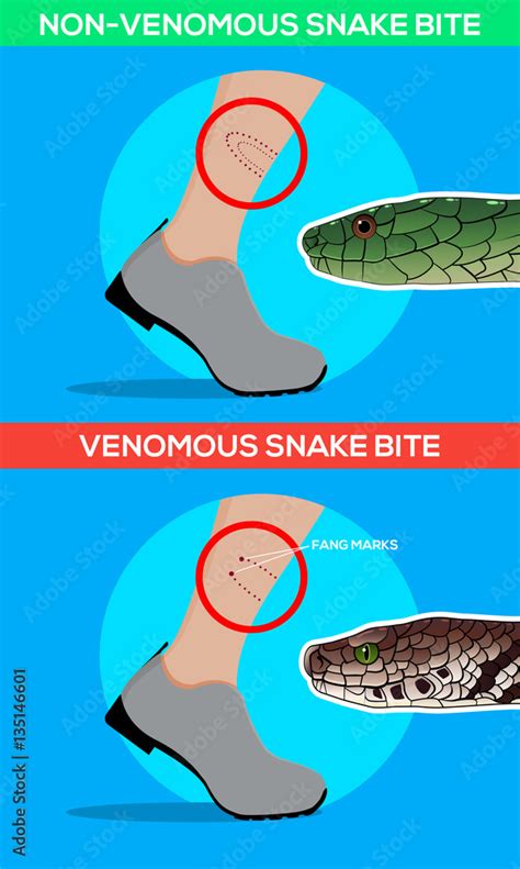 Venomous and non venomous snake bite in the leg. Snakebite. Beware of ...