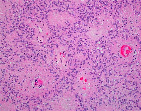 Ependymoma Pseudorosettes