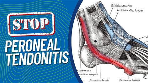 Peroneal Tendonitis