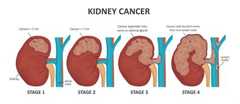 Kidney (Renal) Cancer: Signs, Diagnosis & Treatment in Singapore | PCC